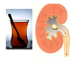 کاهش خطر سنگ کلیه با مصرف چای سیاه