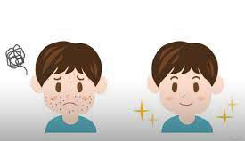 ماش درمان آکنه